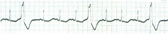 ECG